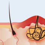 Врослі волосини та глибоке бікіні: як лазер допомагає вирішити проблему