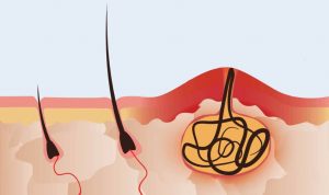 Врослі волосини та глибоке бікіні: як лазер допомагає вирішити проблему