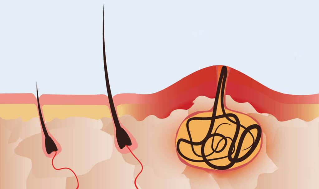 Врослі волосини та глибоке бікіні: як лазер допомагає вирішити проблему
